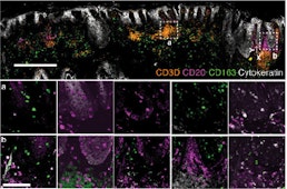 Immune Profiling of Dermatologic Adverse Events from Checkpoint Blockade using Tissue Cyclic Immunofluorescence: A Pilot Study.