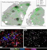 Phase II Study of Eribulin plus Pembrolizumab in Metastatic Soft Tissue Sarcomas: Clinical Outcomes and Biological Correlates.