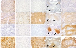 Systematic characterization of antibody-drug conjugate targets in central nervous system tumors.